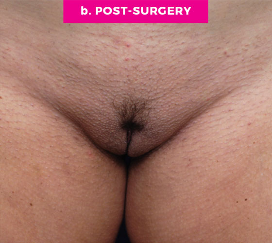LABIA MAJORA REMODELING Patient 2 After