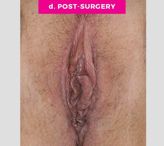 LABIA MAJORA REMODELING Patient 2 After 2