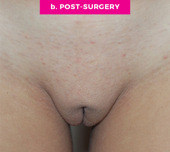LABIA MAJORA REMODELING Patient 3 After