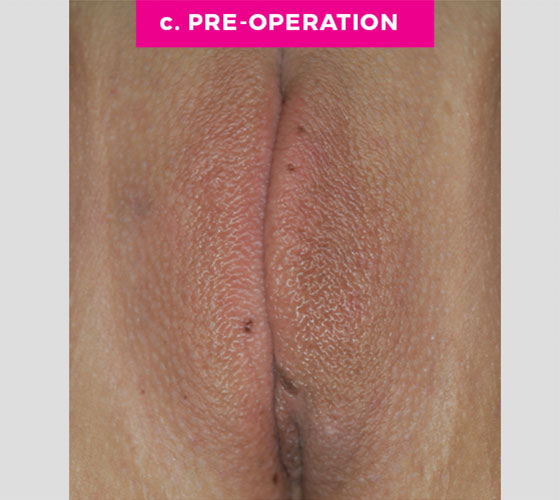 LABIA MAJORA REMODELING Patient 3 Before 2