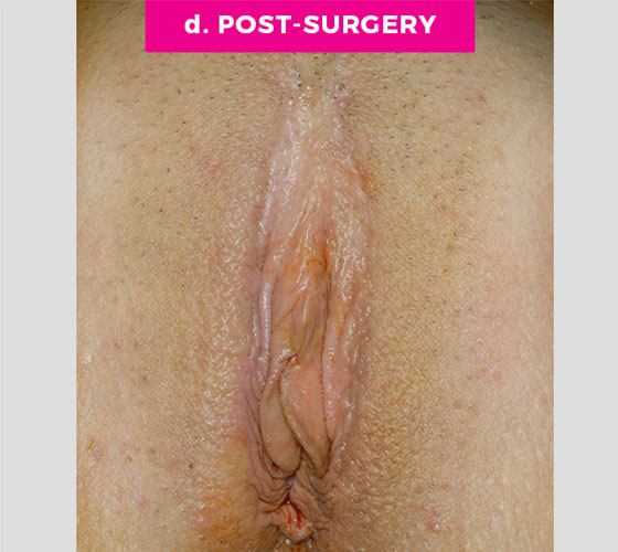 LABIA MAJORA REMODELING Patient 3 After 2