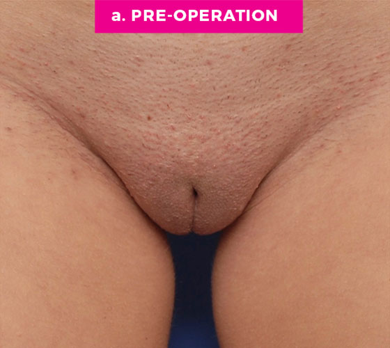 LABIA MAJORA REMODELING Patient 4 Before
