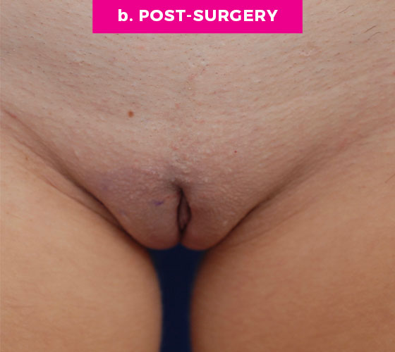 LABIA MAJORA REMODELING Patient 4 After
