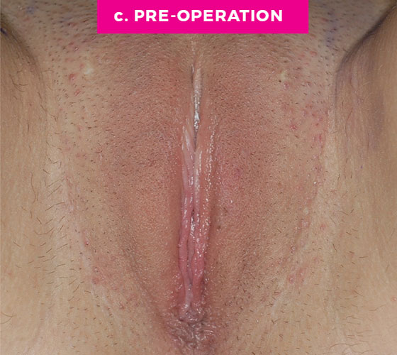 LABIA MAJORA REMODELING Patient 4 Before 2