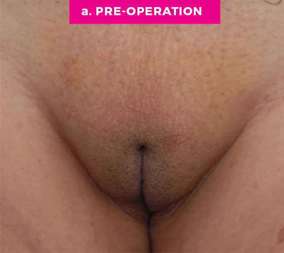 LABIA MAJORA REMODELING Patient 5 Before