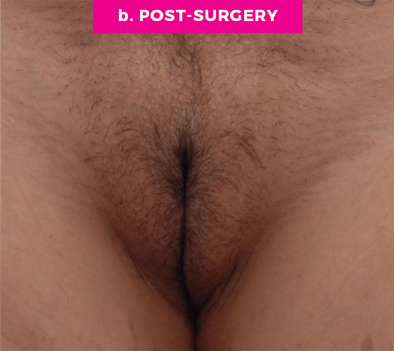 LABIA MAJORA REMODELING Patient 5 After
