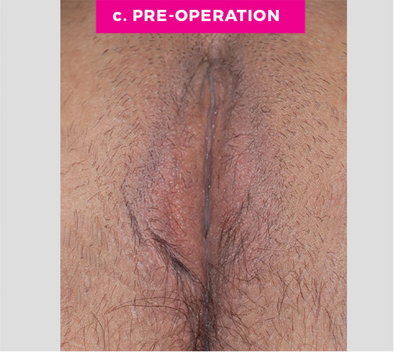 LABIA MAJORA REMODELING Patient 5 Before 2
