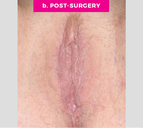LABIA MAJORA REMODELING Patient 5 After