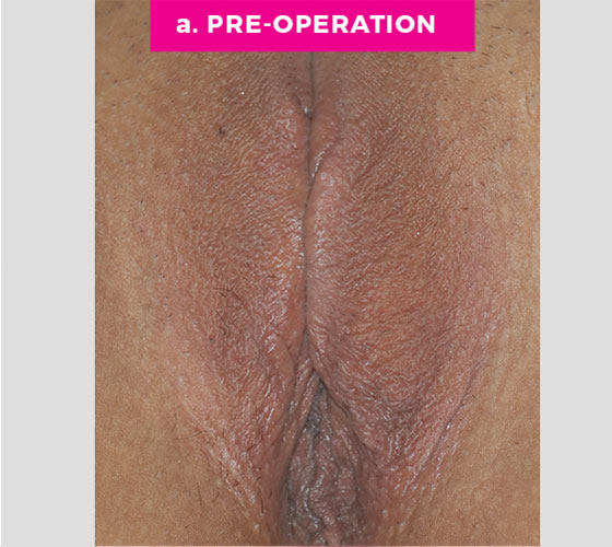 LABIA MAJORA REMODELING Patient 7 Before