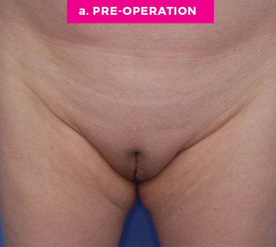 LABIA MAJORA REMODELING Patient 8 Before