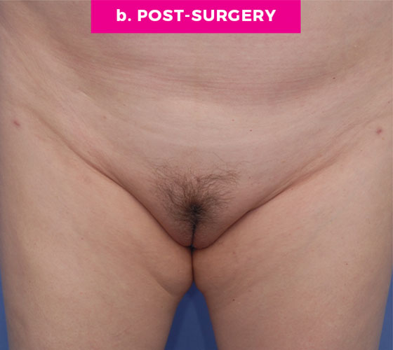 LABIA MAJORA REMODELING Patient 8 After