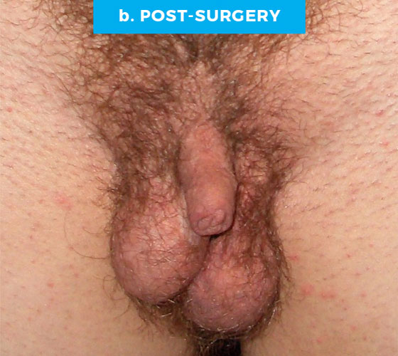 FEMALE TO MALE METAIDOIOPLASTY Patient 1 After