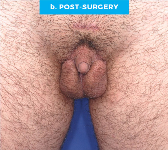 FEMALE TO MALE METAIDOIOPLASTY Patient 5 After