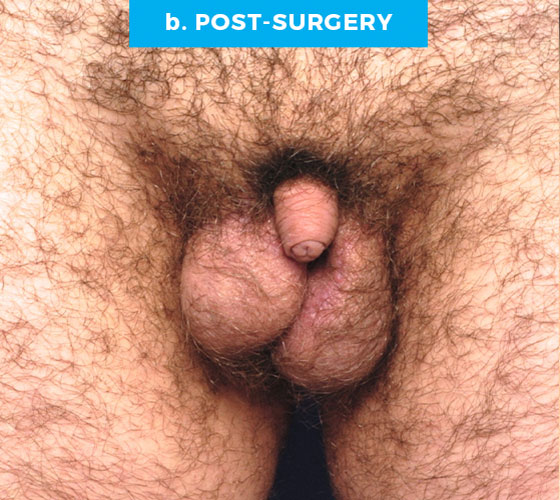 FEMALE TO MALE METAIDOIOPLASTY Patient 5 After
