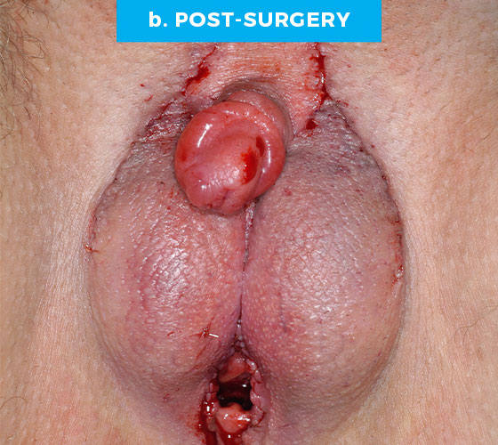 FEMALE TO MALE METAIDOIOPLASTY Patient 6 After