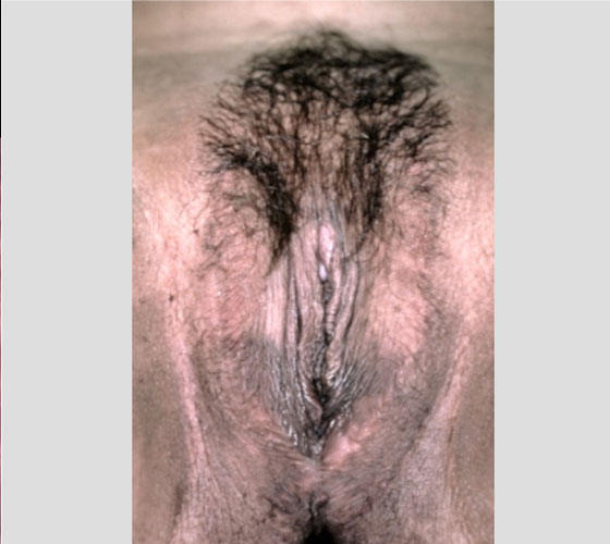 MALE TO FEMALE GENDER CONFIRMATION SURGERY Patient 2