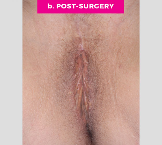 MALE-TO-FEMALE SEX REASSIGNMENT REVISIONS Patient 3 After