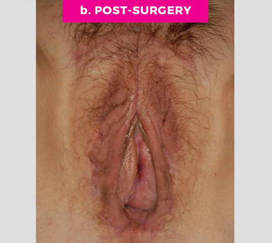 MALE-TO-FEMALE SEX REASSIGNMENT REVISIONS Patient 4 After