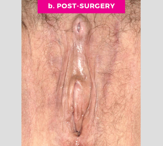 MALE-TO-FEMALE SEX REASSIGNMENT REVISIONS Patient 7 After