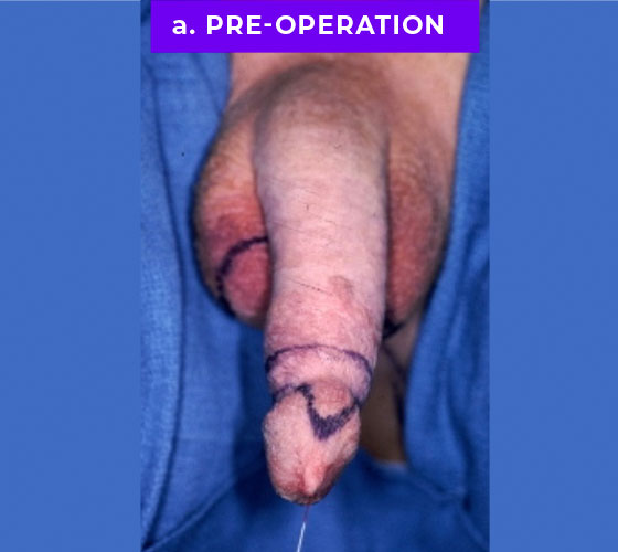 MALE TO FEMALE GENDER CONFIRMATION SURGERY Patient 1 Before