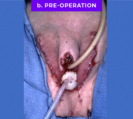 MALE TO FEMALE GENDER CONFIRMATION SURGERY Patient 1 After
