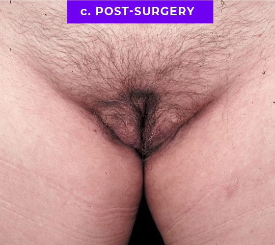 MALE TO FEMALE GENDER CONFIRMATION SURGERY Patient 1 After 2