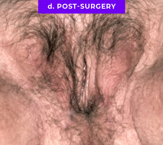 MALE TO FEMALE GENDER CONFIRMATION SURGERY Patient 1 After 6