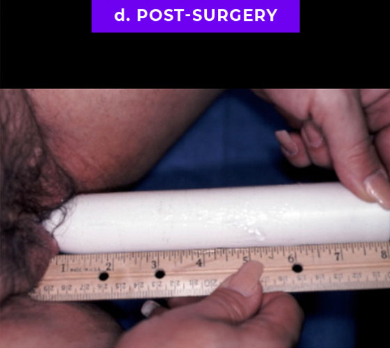 MALE TO FEMALE GENDER CONFIRMATION SURGERY Patient 1 After 8