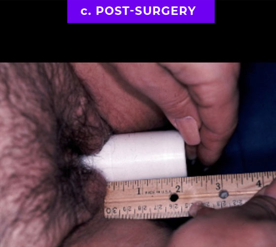 MALE TO FEMALE GENDER CONFIRMATION SURGERY Patient 1 After 5