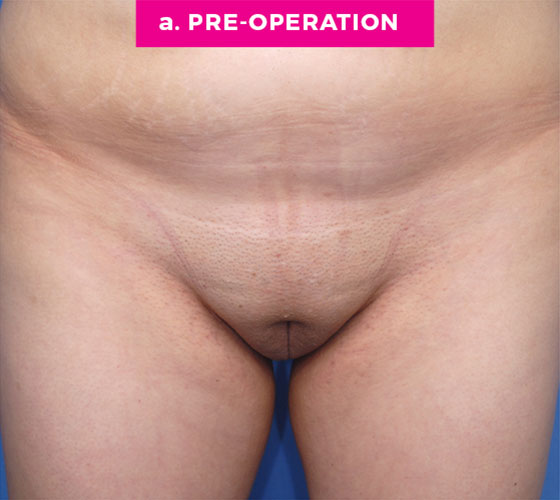 Pubic Liposuction Patient 1 Before