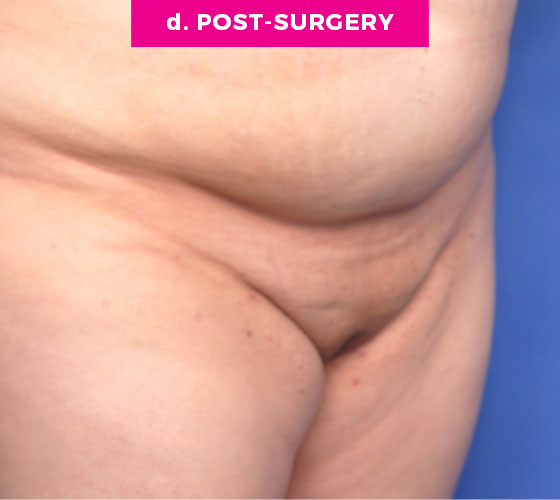 Pubic Liposuction Patient 1 After 2