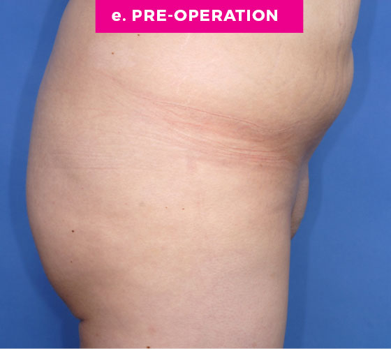 Pubic Liposuction Patient 1 Before 3