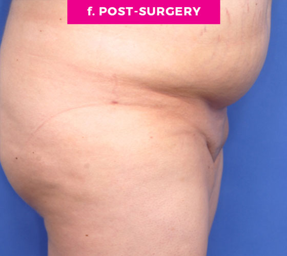 Pubic Liposuction Patient 1 After 3