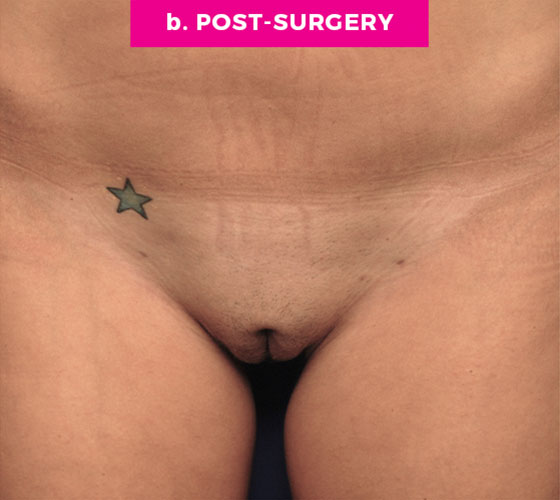 Pubic Liposuction Patient 2 After