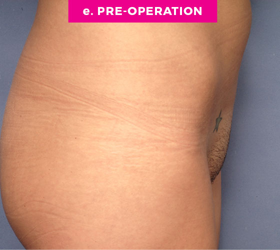 Pubic Liposuction Patient 2 Before 3