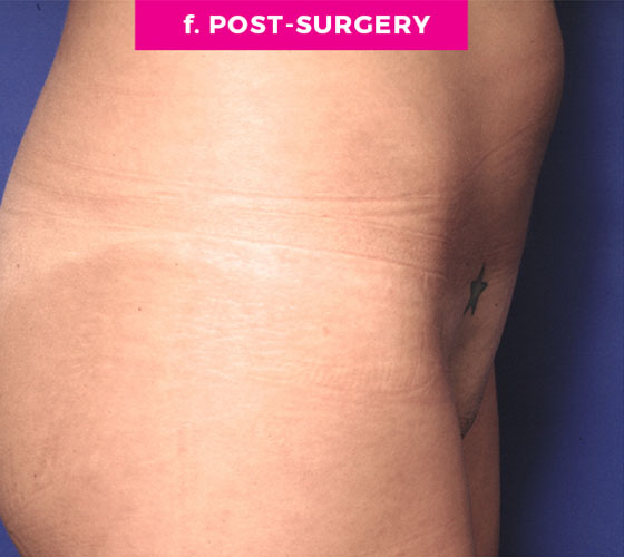 Pubic Liposuction Patient 2 After 3