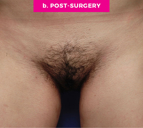 Pubic Liposuction Patient 3 After