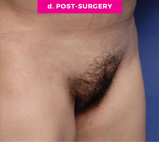 Pubic Liposuction Patient 3 After 2