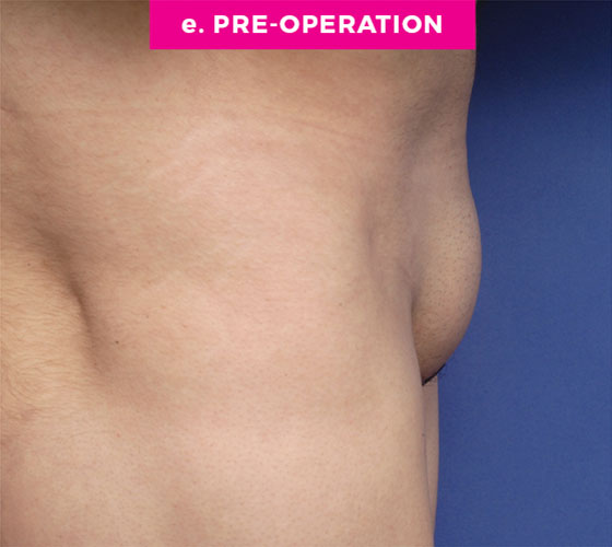 Pubic Liposuction Patient 3 Before 3