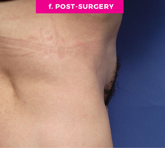 Pubic Liposuction Patient 3 After 3