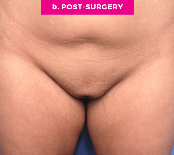 Pubic Liposuction Patient 4 After