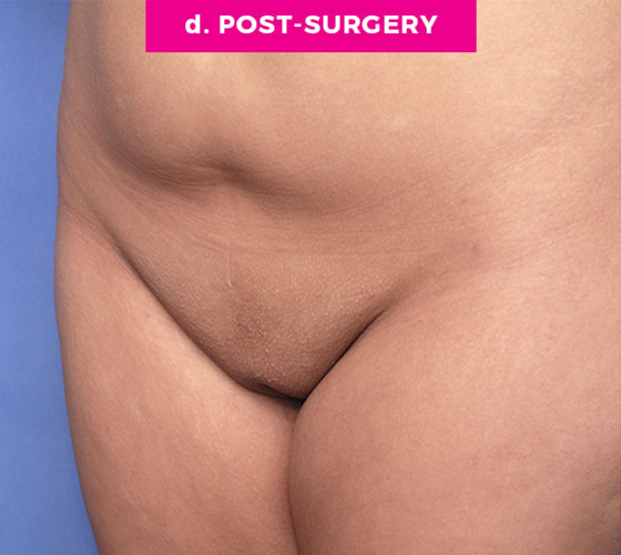 Pubic Liposuction Patient 4 After 2