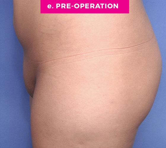 Pubic Liposuction Patient 4 Before 3