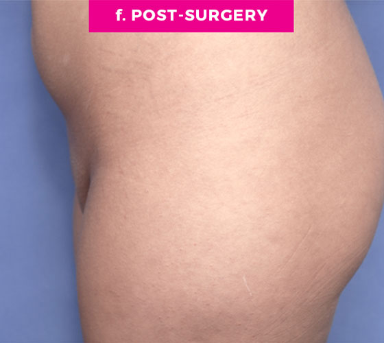 Pubic Liposuction Patient 4 After 3