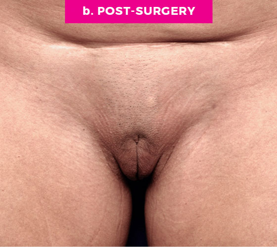 Pubic Liposuction Patient 5 After