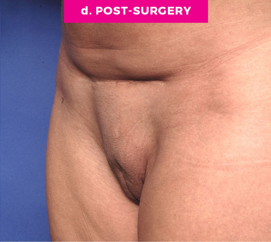 Pubic Liposuction Patient 5 After 2
