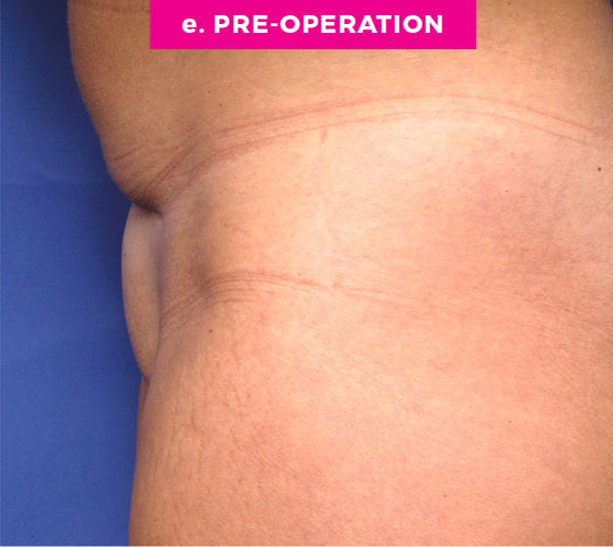 Pubic Liposuction Patient 5 Before 3