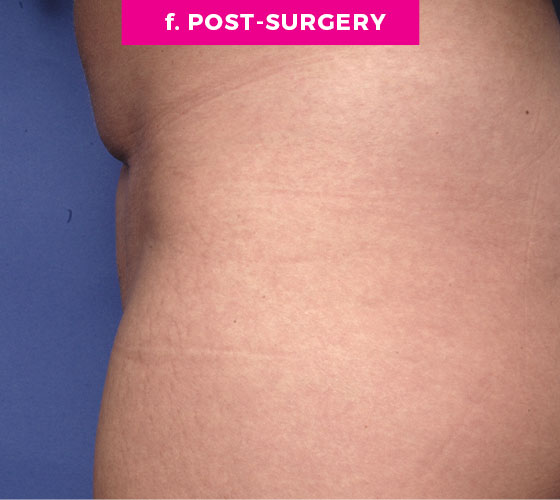 Pubic Liposuction Patient 5 After 3