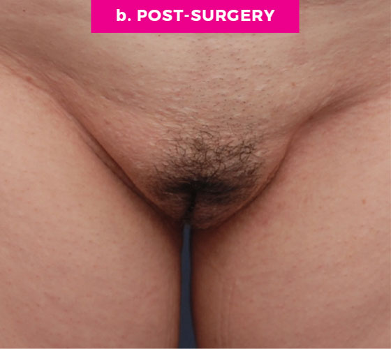 Pubic Liposuction Patient 6 After
