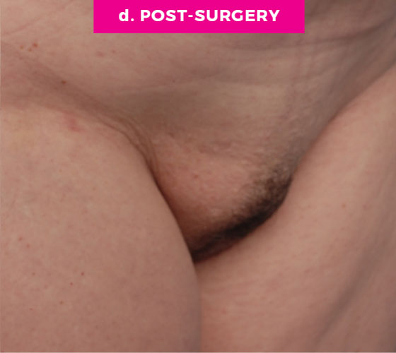 Pubic Liposuction Patient 6 After 2